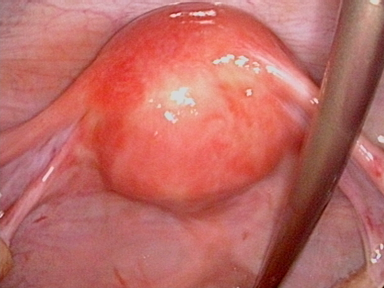 rupture corpus luteum after romal of blood